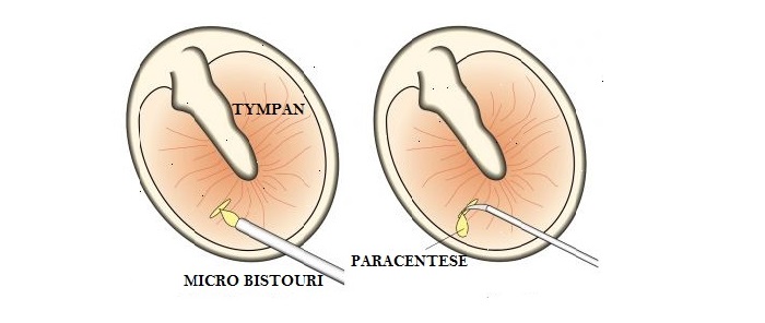 Paracentèse Chirurgie ORL Enfant Nantes - Dr Christophe GRIFON
