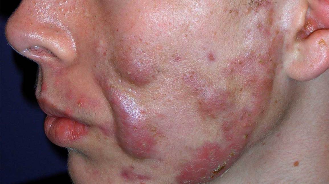 Acne Conglobata: Symptoms, Causes, Treatment, and More