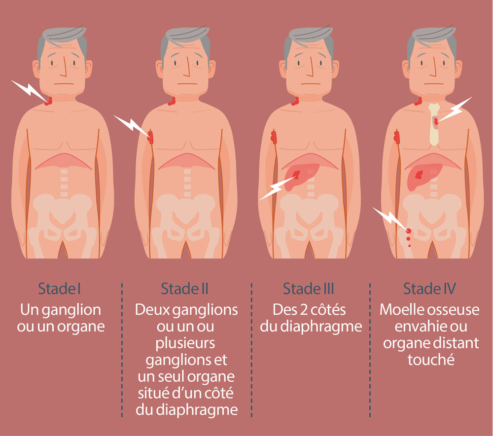 Comprendre lymphome non hodgkinien | Roche Belgique