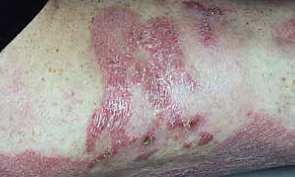 Comment je traite le mycosis fongoïde en 2018 - Réalités thérapeutiques en  Dermato-Vénérologie