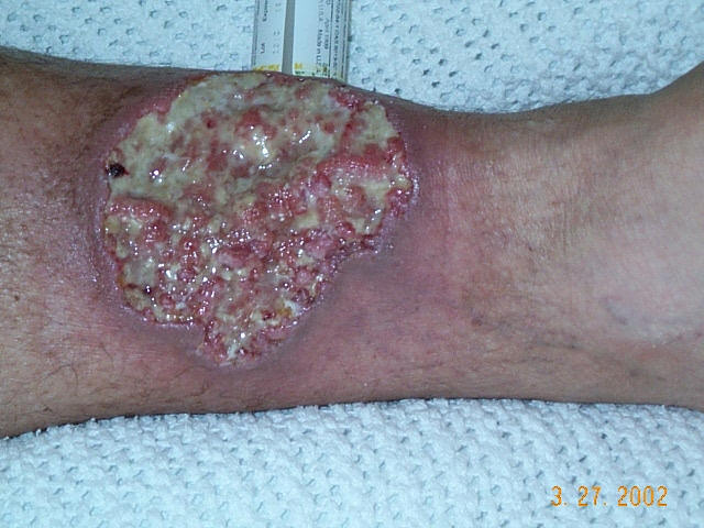 Pyoderma gangrenosum — Wikipédia