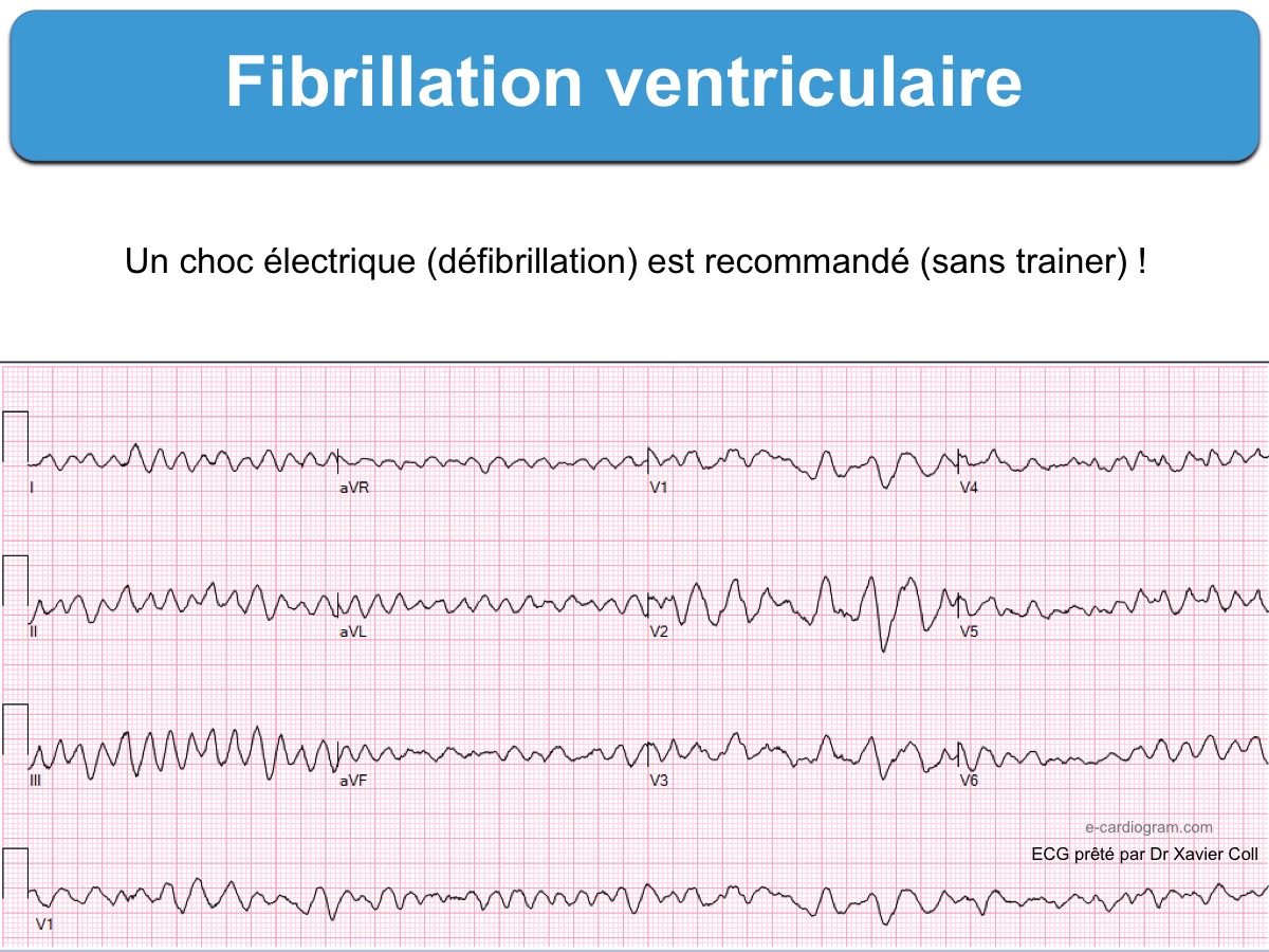 Fibrillation ventriculaire. FV : e-cardiogram