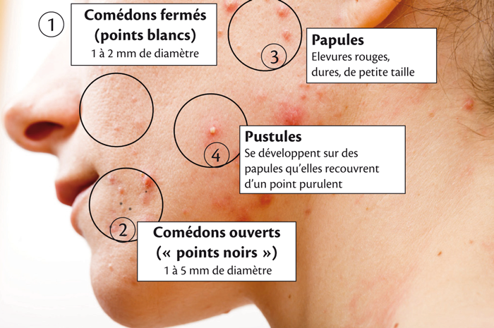L'acné : une maladie du follicule pilo-sébacé