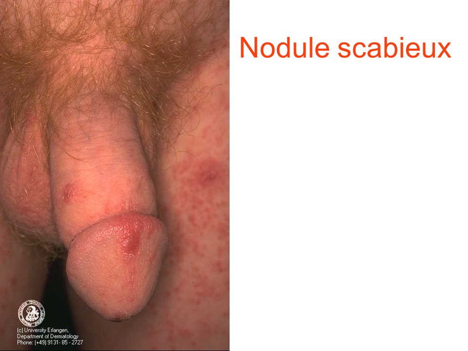 Ectoparasitoses cutanées Gale Pédiculoses - ppt télécharger