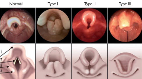 Laryngomalacie : cause principale de stridor chez le nourrisson et le petit  enfant