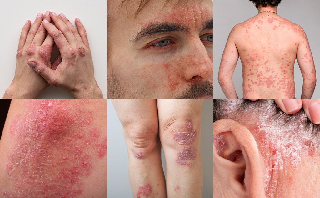 Actualité des dermatologues : Le psoriasis