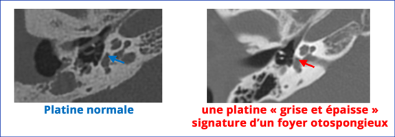 diagnostic otospongiose