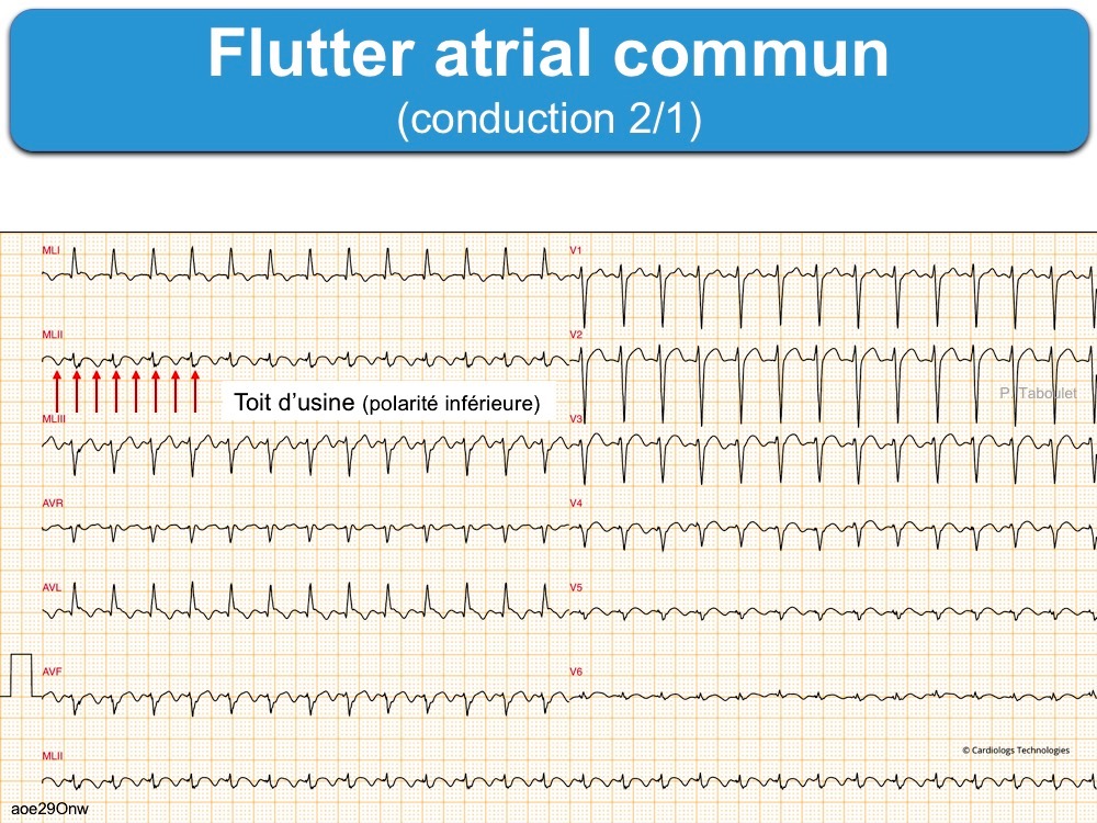 Flutter atrial 1. Généralités : e-cardiogram