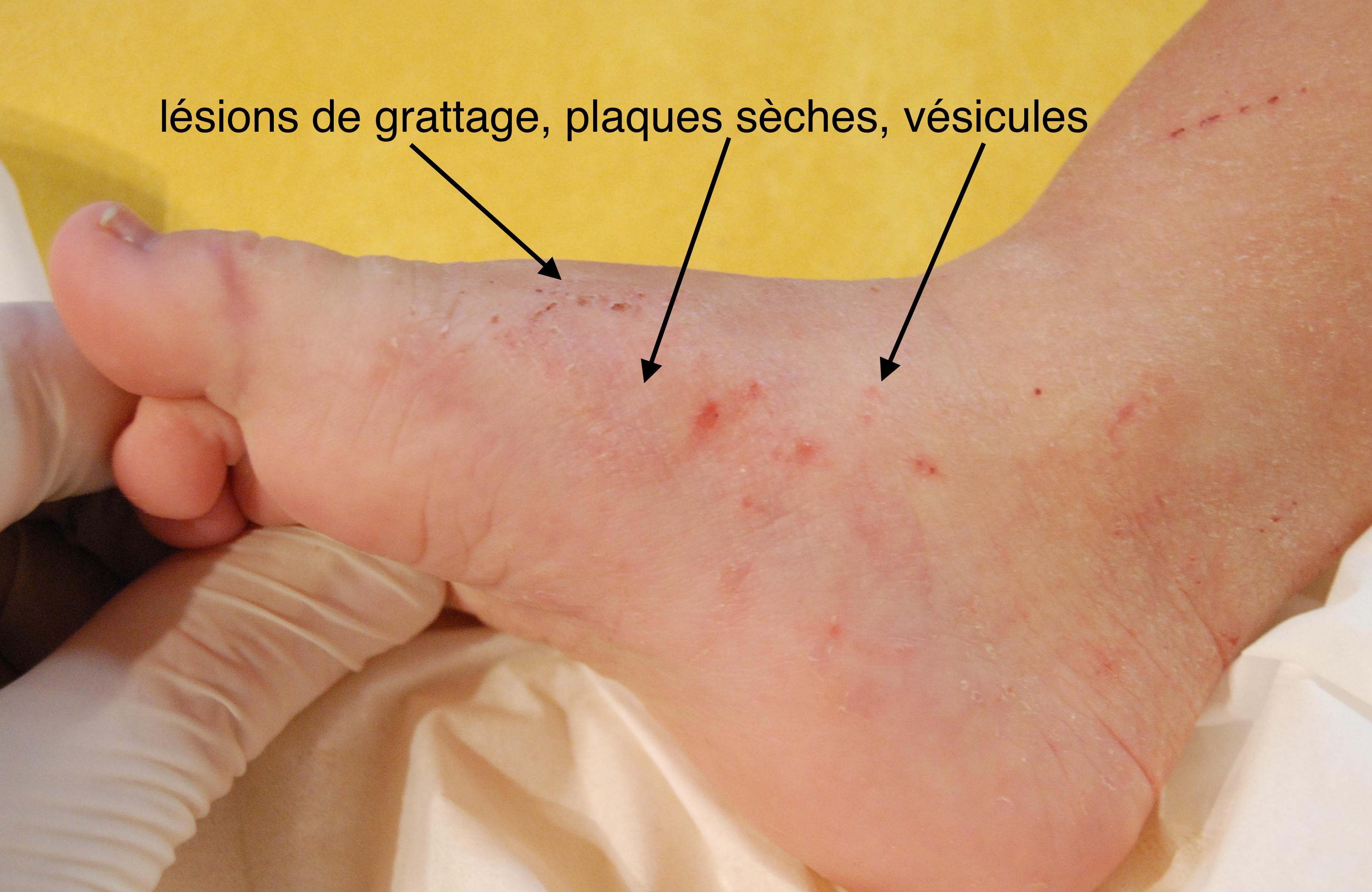 DERMATO-INFO, la gale