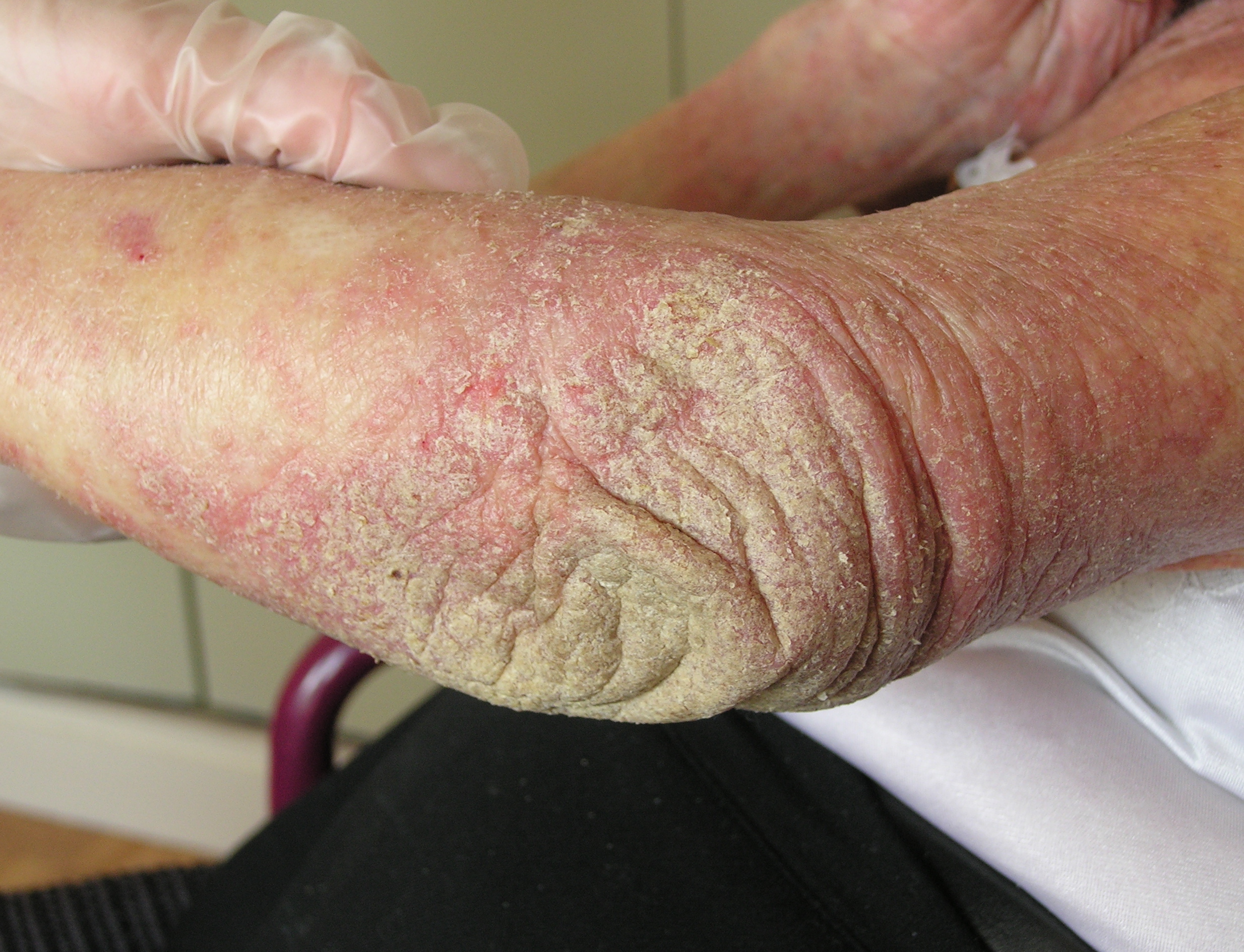 DERMATO-INFO, la gale