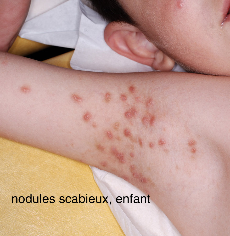 DERMATO-INFO, la gale