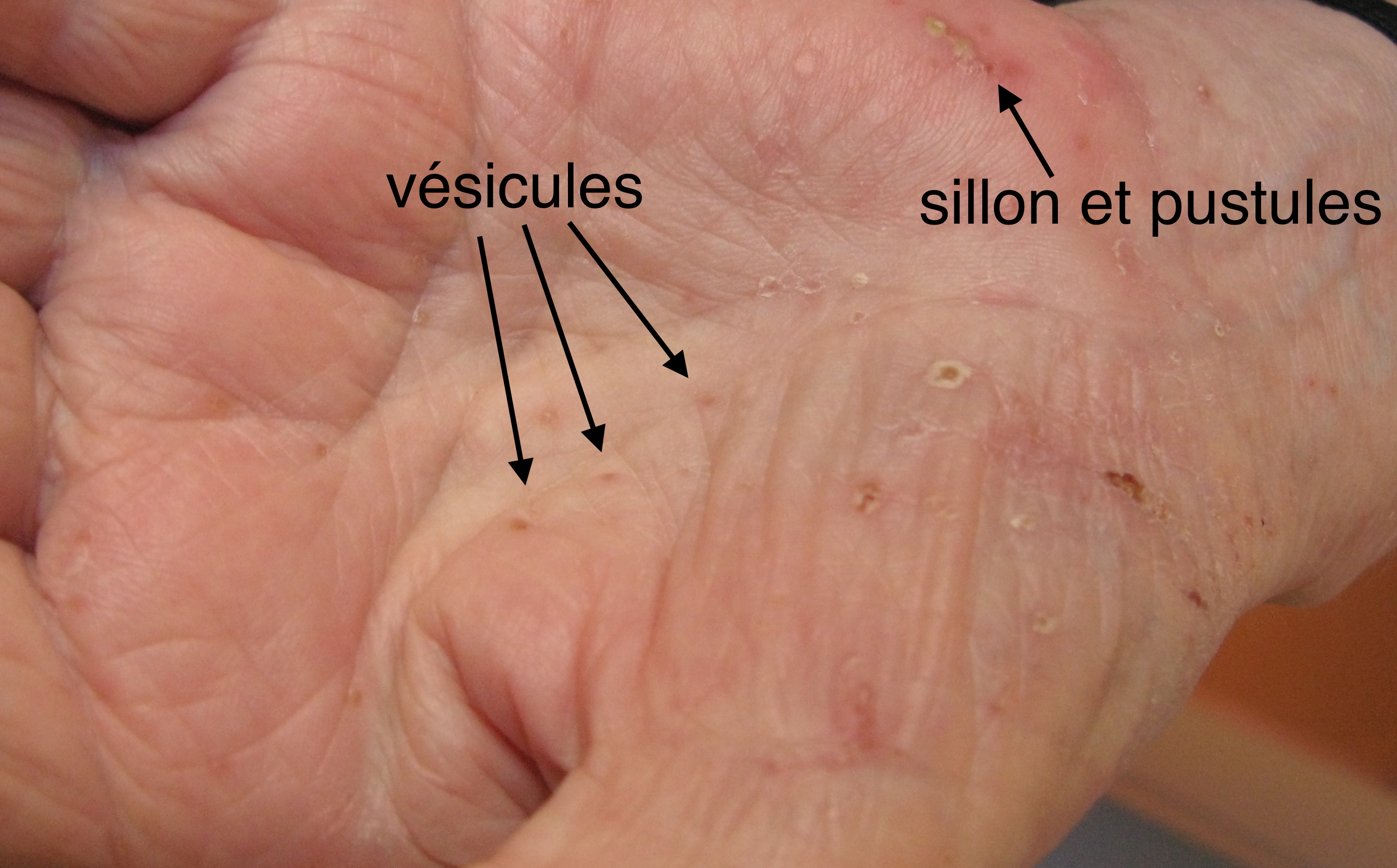 DERMATO-INFO, la gale