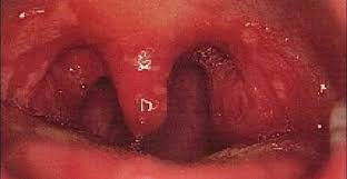 Dr. Bouti Abdelmoumen - #Angines_vésiculeuses Elles sont caractérisées par  une exulcération du revêtement épithélial, succédant à une éruption  vésiculeuse fugace au niveau des amygdales et des piliers. L'angine  herpétique en est l'exemple,