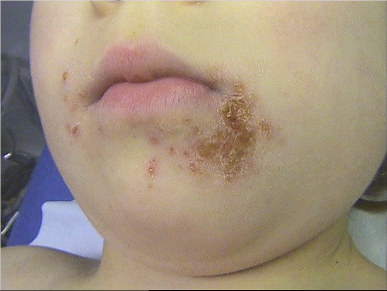 DERMATO-INFO, les infections bactériennes