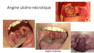infections OttoRhinoLaryngologie antibiotherapie .pptx