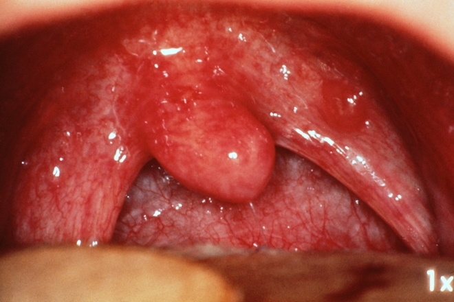 Angine : attention aux complications ! - AlloDocteurs