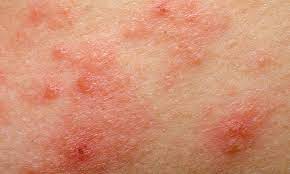 Quoi de neuf dans la dermatite atopique ? - Réalités thérapeutiques en  Dermato-Vénérologie