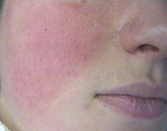 DERMATO-INFO, la couperose et la rosacée