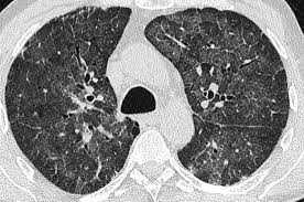 IMAGERIE DE LA PNEUMOCYSTOSE CHEZ PATIENTS SOUS IMMUNOSUPPRESSEURS